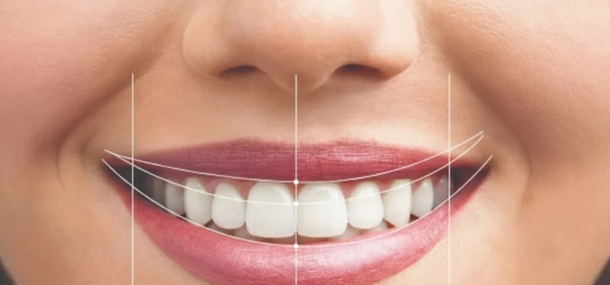 Aesthetic Smile Design (Veneers)