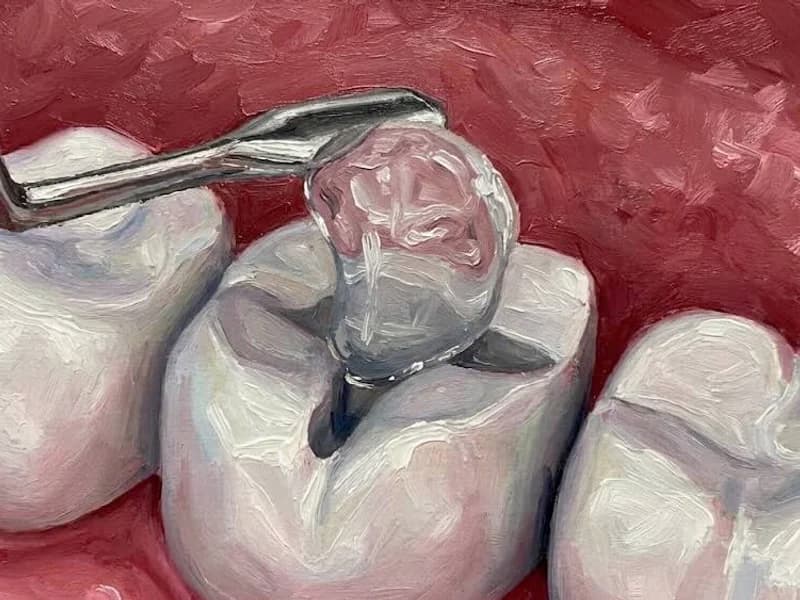 Aesthetic Resin Filling - Tooth-colored cavity filling