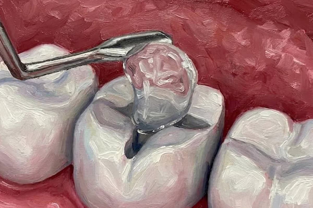 Aesthetic Resin Filling - Tooth-colored cavity filling