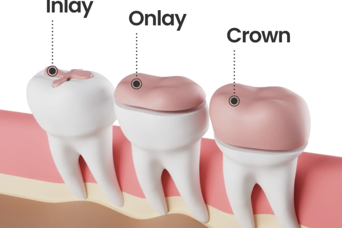 Ceramic Inlays & Onlays - Custom-milled ceramic fillings