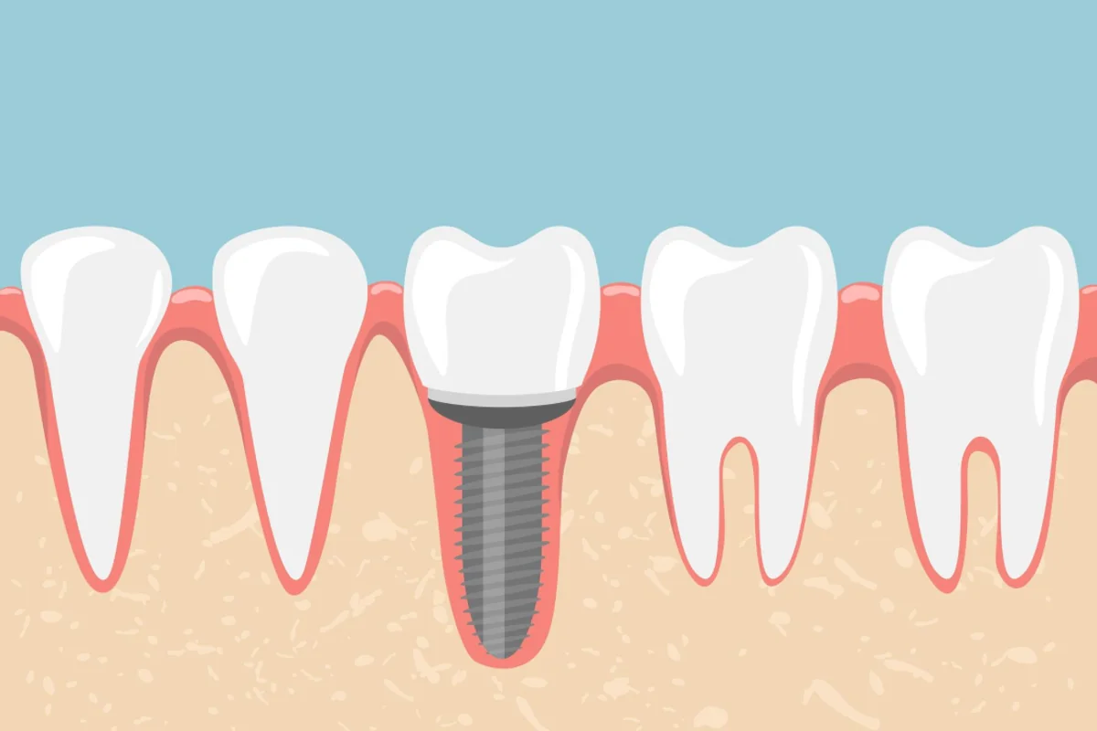 Dental Implants - Advanced titanium or zirconia tooth replacement