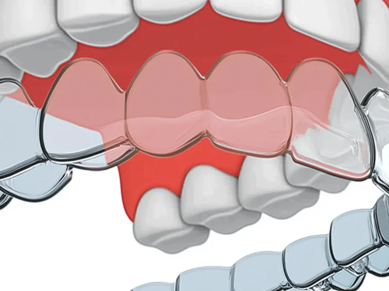 Invisalign Clear Aligners - Discreet removable aligners for teeth straightening
