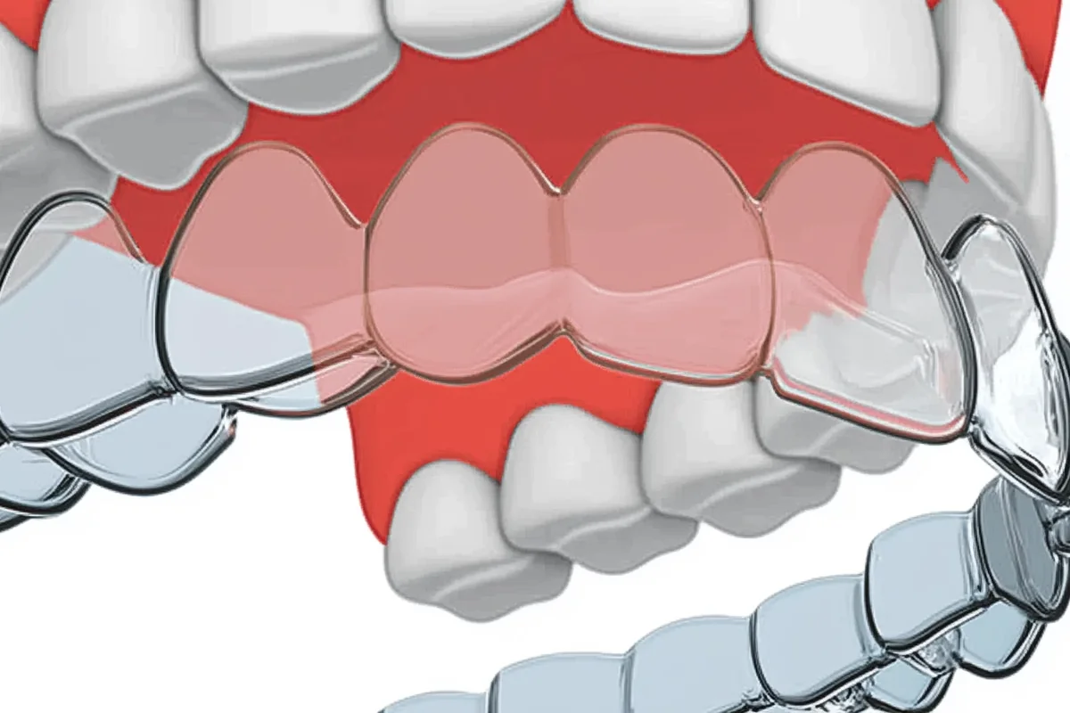 Invisalign Clear Aligners - Discreet removable aligners for teeth straightening