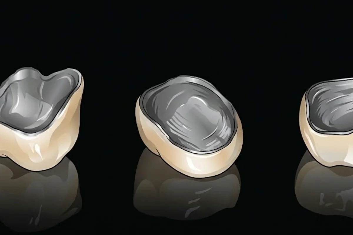 PFM Crowns Insured - Porcelain-Fused-to-Metal dental crowns