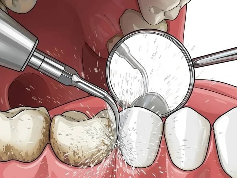 Scaling Cleaning - Professional ultrasonic plaque and tartar removal