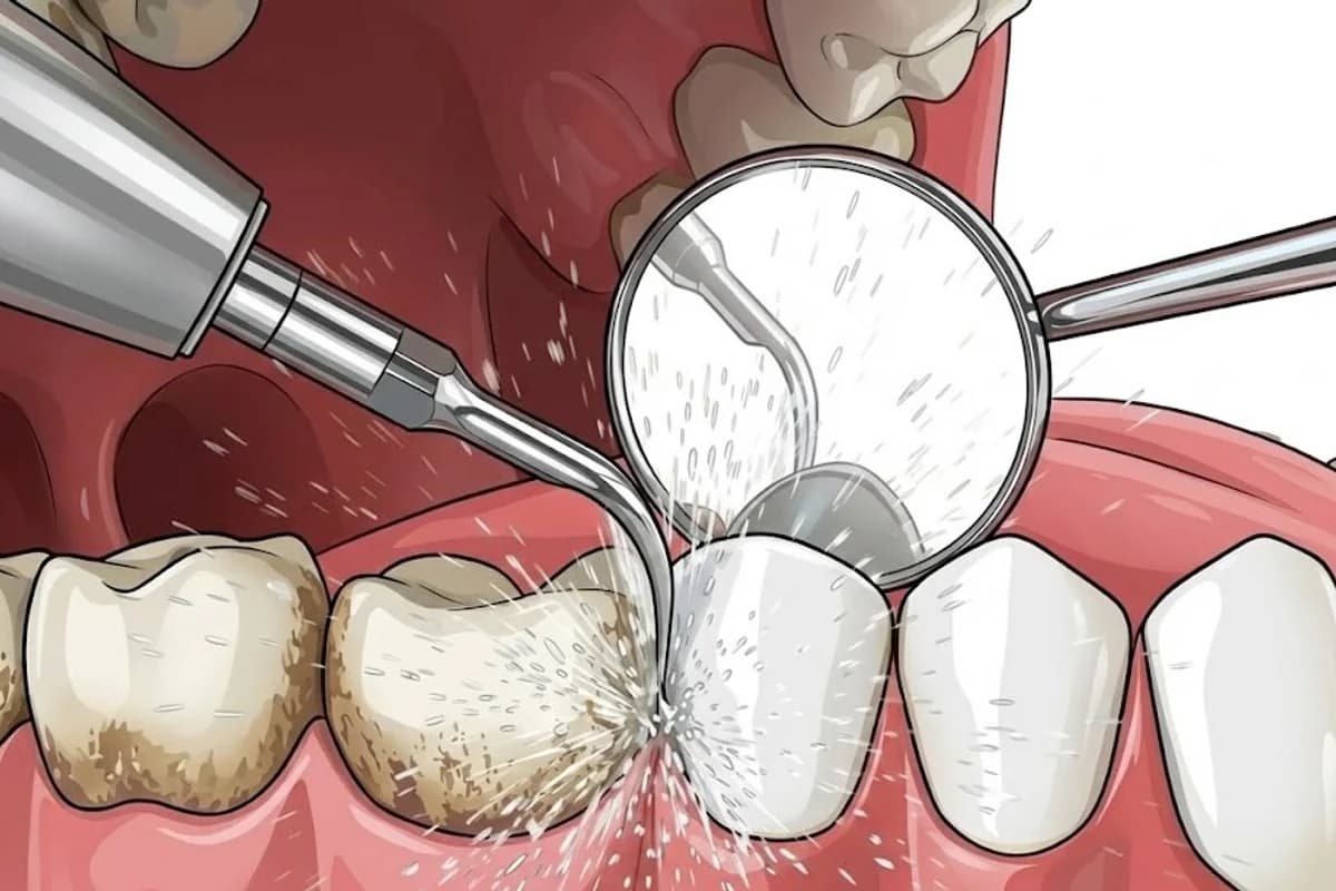 Scaling Cleaning - Professional ultrasonic plaque and tartar removal