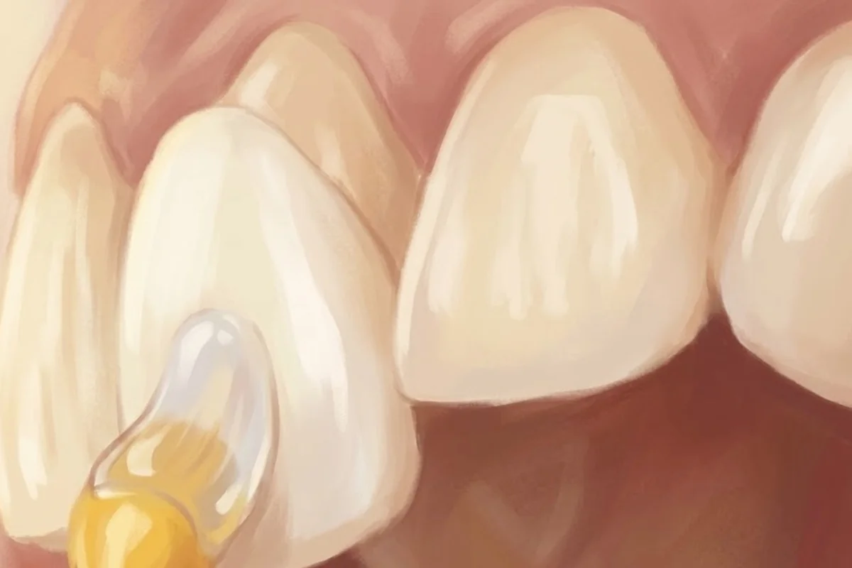 Veneers Laminates - Custom porcelain shells for Hollywood smile